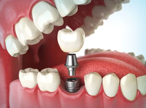 dental implant illustration
