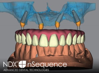 Dental implant visualization