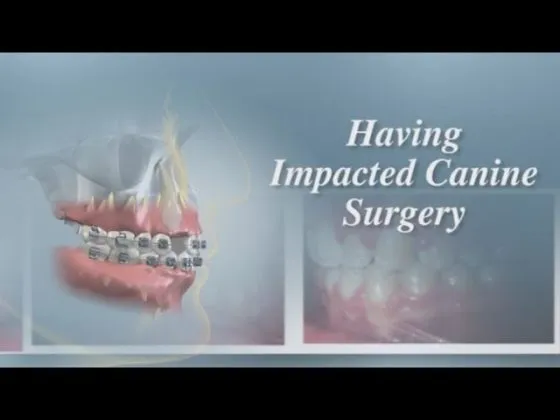 Having impacted canine surgery thumbnail