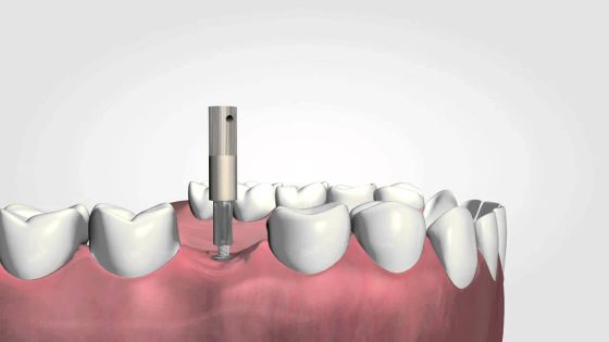 Osstell ISQ the only objective way to measure implant stability thumbnail